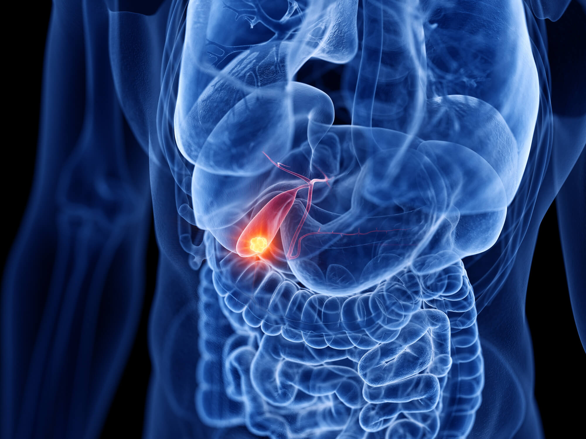 Gallbladder Cancer: Gallstones Link, Radical Cholecystectomy & Bile Duct Care